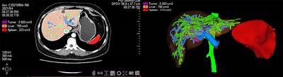 Splenic Volume, an Easy-To-Use Predictor of HCC Late Recurrence for HCC Patients After Hepatectomy